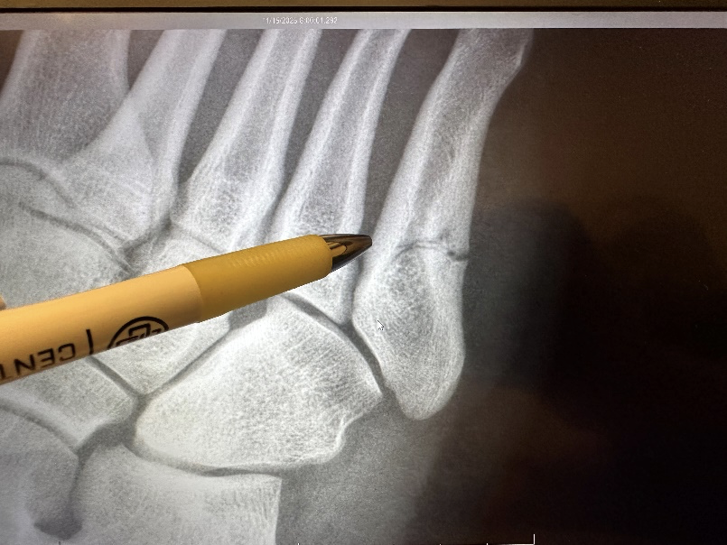 Jones Fracture x-ray at Ortho Central