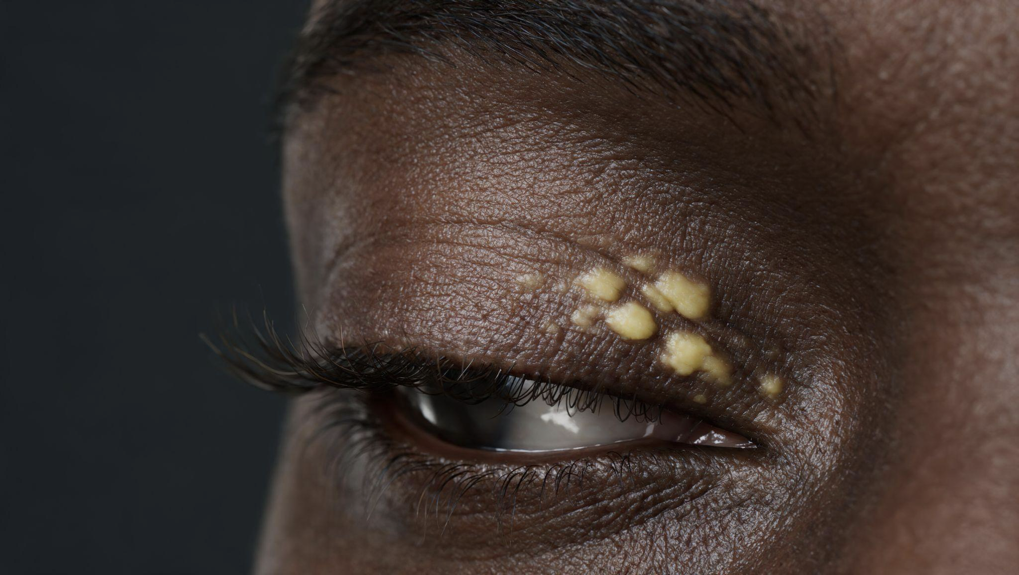 Extremely high cholesterol around eyes