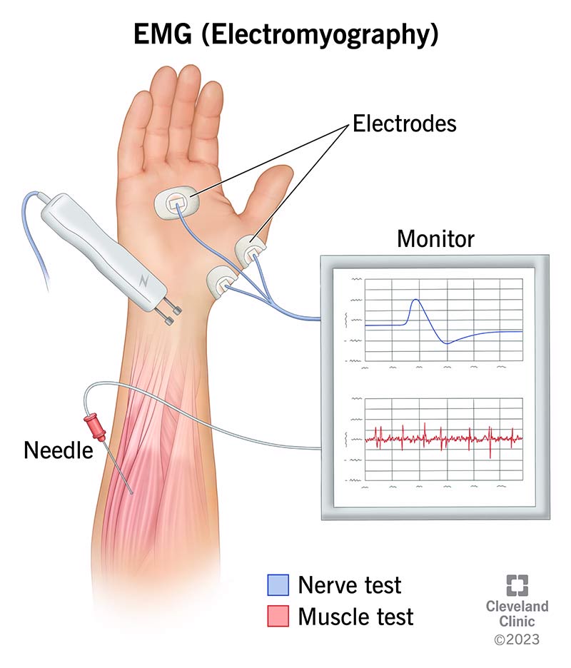 Electromyography (EMG) testing diagram. 