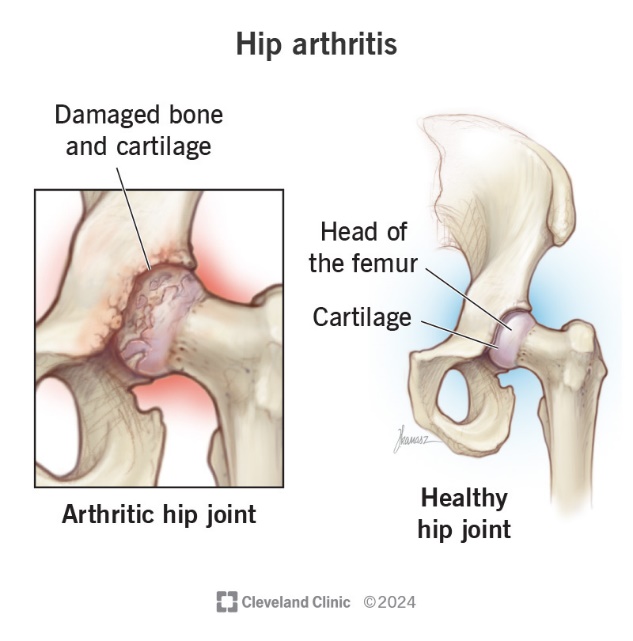 Image of healthy hip joint and an arthritic hip joint. 